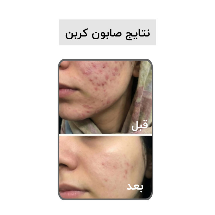 صابون کربن فعال بیز ضدجوش ، ضد لک و روشن کننده پوست