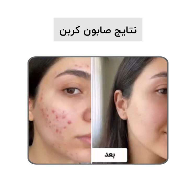 صابون کربن فعال بیز ضدجوش ، ضد لک و روشن کننده پوست