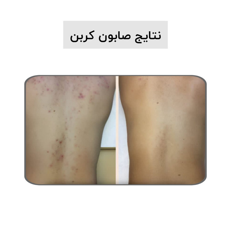 صابون کربن فعال بیز ضدجوش ، ضد لک و روشن کننده پوست