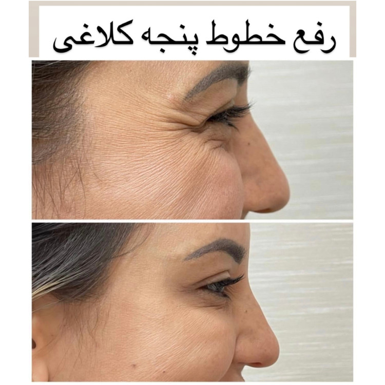 کرم بیوممتیک ضدچین و چروک ۴۰ml گاتیو 5 کاره | جوانسازی ، لیفت کننده و آبرسان | نمایندگی اصلی
