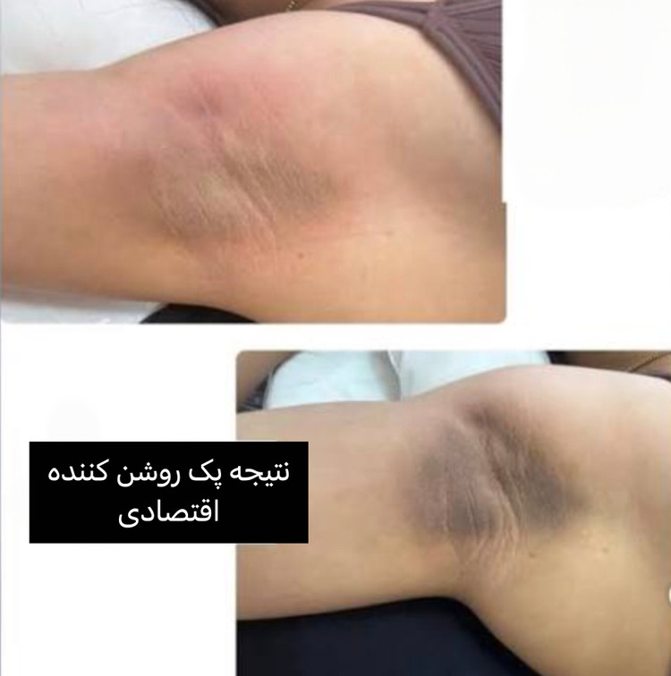 پک روشن کننده و رفع تیرگی بدن ویتابلا (لایه برداری عمقی)