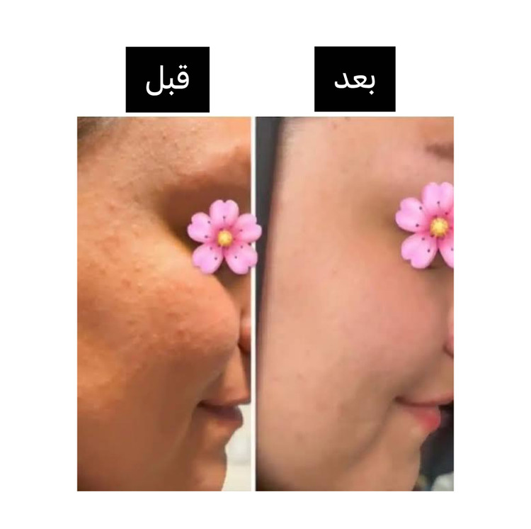 سرم مغذی ۱۵ کاره لاکچری کوین ۳۰ml جوانسازی کاهش منافذ و ضد لک