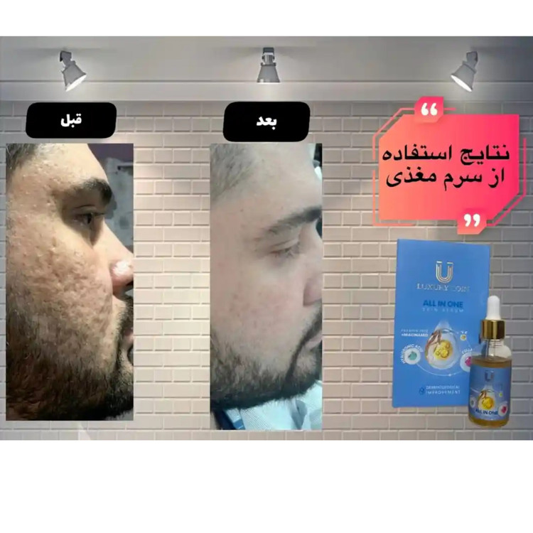 سرم مغذی ۱۵ کاره لاکچری کوین ۳۰ml جوانسازی کاهش منافذ و ضد لک